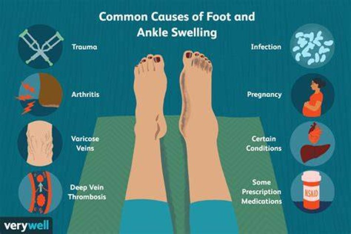 Why One Foot, Ankle, or Leg Might Be Swollen